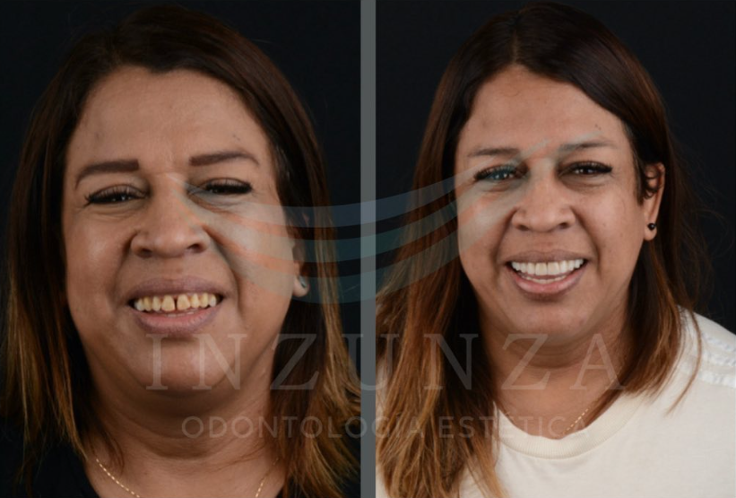 Diseño de Sonrisas en Culiacán